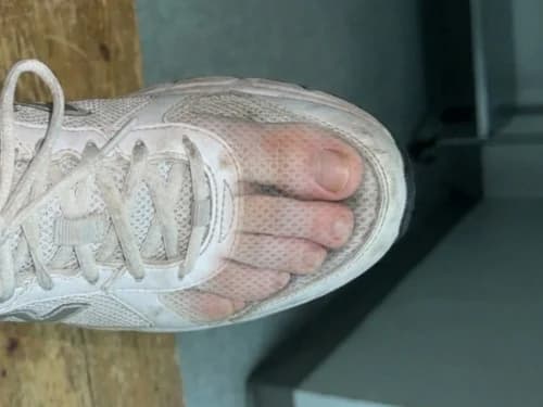 Dolore ai piedi durante la corsa